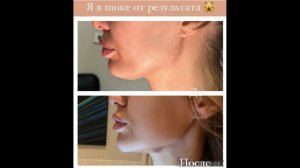 Виктория Боня о результате первой пластики