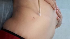 Криодеструкция себорейного кератоза.