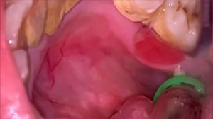 Calculus Removal - Massive Tartar | Чистка зубного Камня