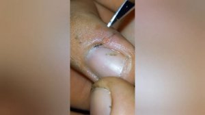 гной в пальце