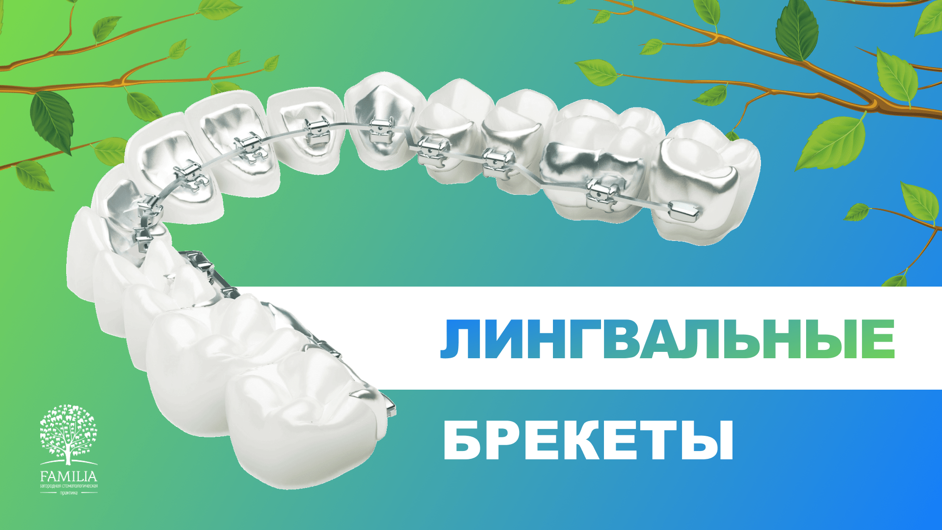 ? Лингвальные брекеты