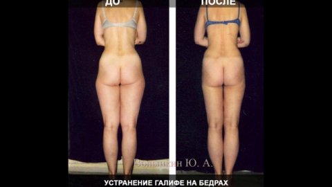 Почему Ручная Пластика лучше липоскации