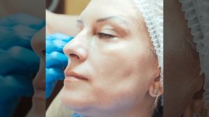 Ендоліфтінг | Эндолифтинг | Лифтинг лица | Смас лифтинг |  Подтяжка лица | Подтяжка кожи Харьков