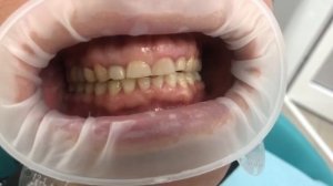 Восстановление высоты прикуса, функции жевания и эстетики с помощью коронок и винир из циркония.