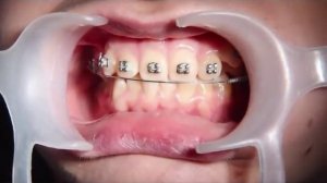 Замена дуги брекет системы