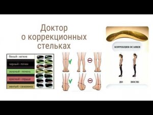 Коррекционные стельки с анионами Гучжэнцзи компании Whieda. Отзыв врача