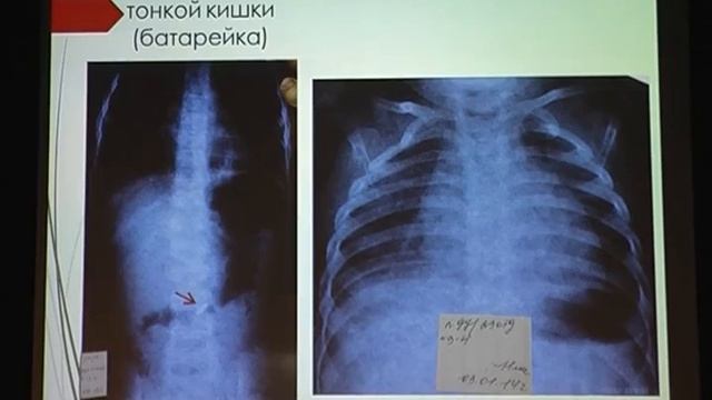34 Лютин Д А  Инородные тела верхних отделов желудочно кишечного тракта у детей