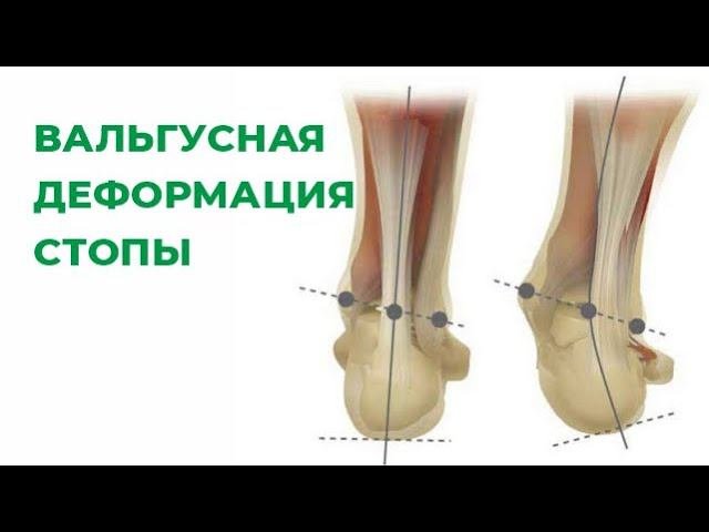 Вальгусная деформация стопы. Исправление вальгуса. Косточка/шишка на стопе. Hallux Valgus.