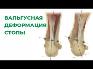 Вальгусная деформация стопы. Исправление вальгуса. Косточка/шишка на стопе. Hallux valgus.