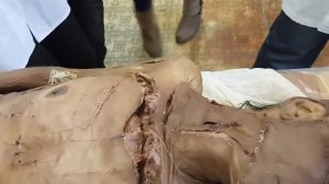 доступ к подключичной артерии