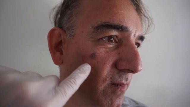 Удаление Пигметного Пятна смотреть онлайн