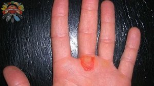 Перекись водорода для кожи – как использовать?