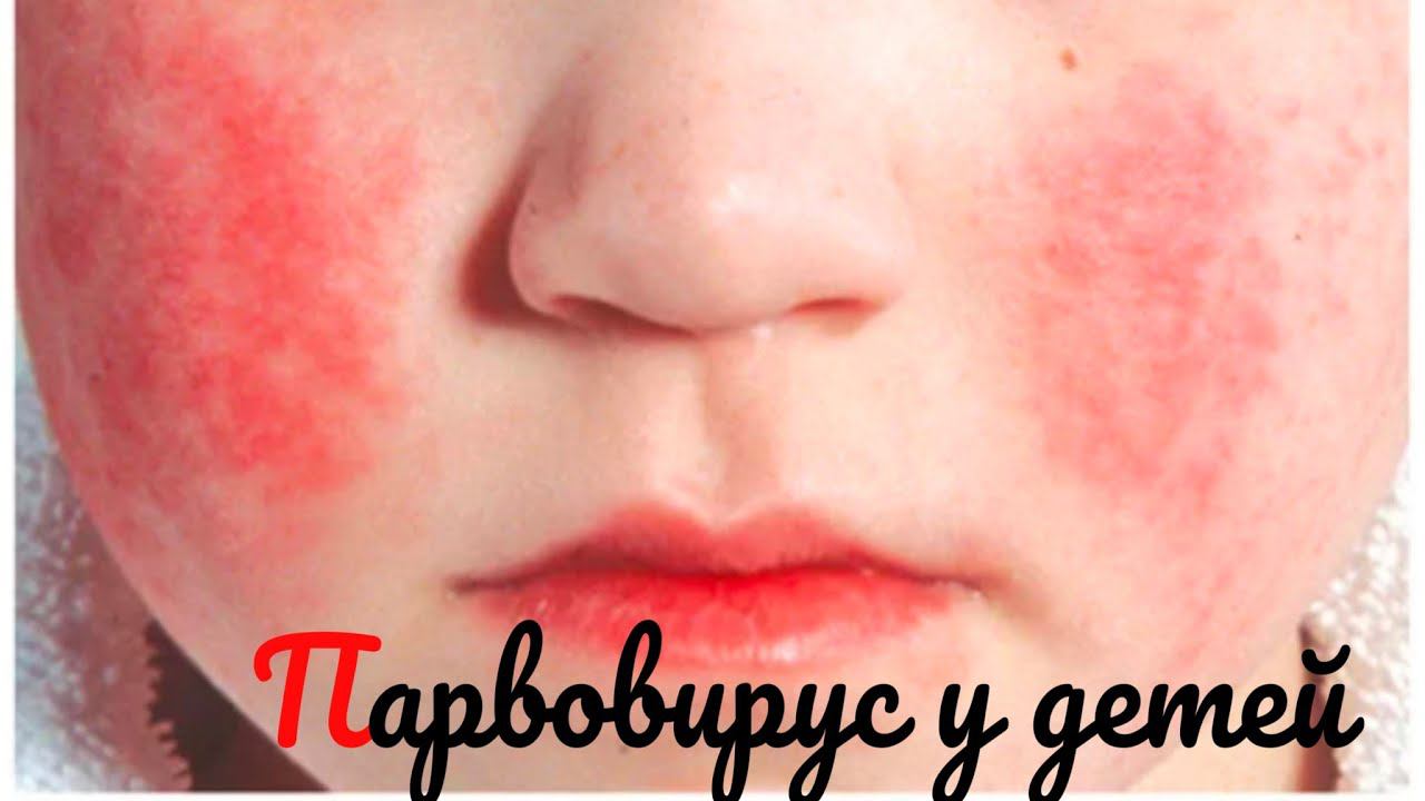 Парвовирусная инфекци. Симптомы проявления,пути передачи,лабораторная диагностика и лечение у детей.