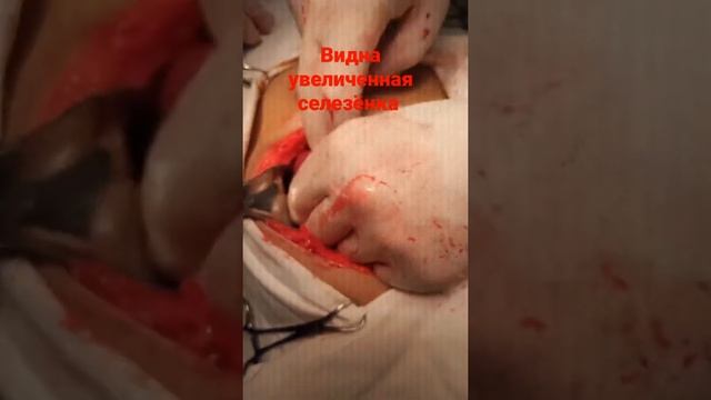 видна увеличенная селезёнка.