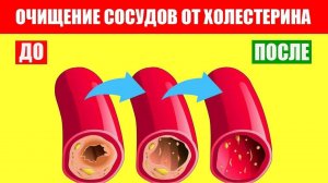 Удаление холестерина из сосудов. Холестериновые бляшки - 2 ч