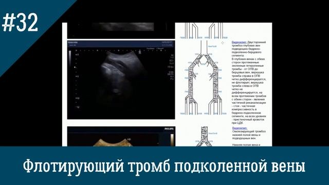 УЗИ вен. Флотирующий тромб подколенной вены (ПКВ) смотреть онлайн