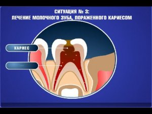 Лечение кариеса молочных зубов