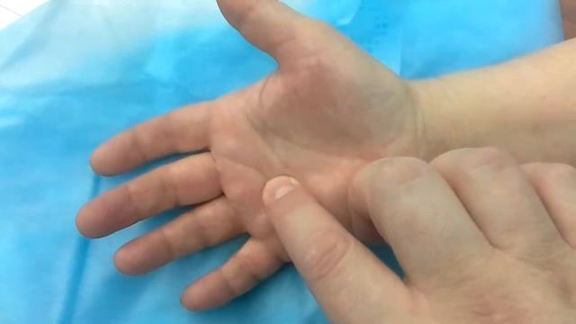 Лигаментит 4 палец правой кисти 3 стадия смотреть онлайн