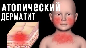 Атопический дерматит у ребенка, основные правила ухода