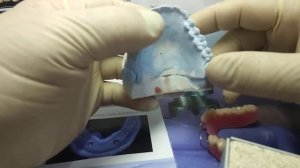 частично съёмный акриловый зубной протез