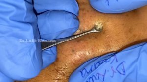 Blackheads Removal Full Video by Dr Lalit Kasana