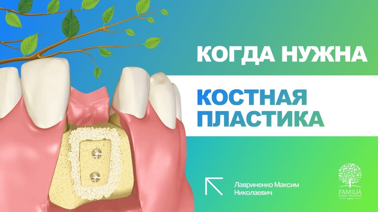 ↪ Когда нужна костная пластика?