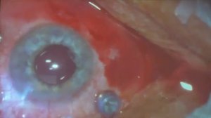 Оперативное лечение регматогенной отслойки сетчатки