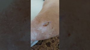 гидроколлоидная повязка
