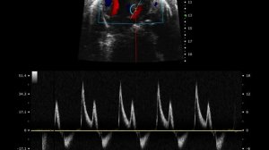 Четыре камеры сердца. Режим импульсно-волнового допплера (PW)