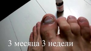 ВЫЛЕЧИЛ грибок Лечение грибка ногтей