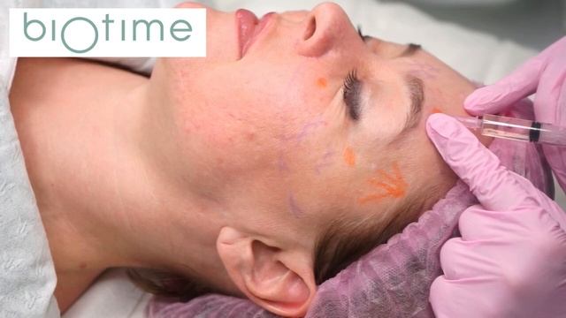 Biomatrix Topaz. Техника "Мимические очки" смотреть онлайн