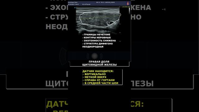 Аутоиммунный тиреоидит на УЗИ смотреть онлайн