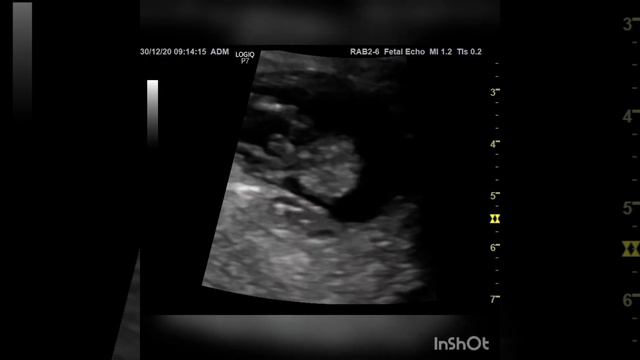 Case 172 : trisomy 13 . 12w fetus смотреть онлайн