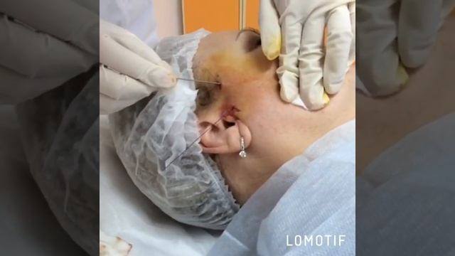 Нитевой лифтинг! Врач Артенян Назели Рафаэловна, Клиника Вита смотреть онлайн