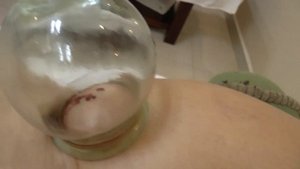 Китайские вакуумные банки. Лечение иглоукалыванием. Госпиталь ТКМ. Санья. Хайнань. Китай ?