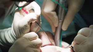 Implantmed SI-1023, удаление моляра. www.apexdental.ru