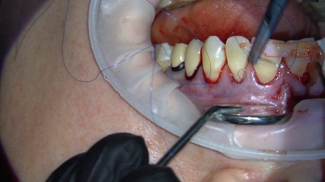 Закрытие рецессии десны туннельной методикой/ Gingival Recession Treatment. Pouch&Tunnel Technique