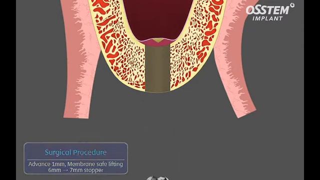 Поднятие перегородки верхнечелюстной пазухи, хирургическая процедура ( CAS-KIT) смотреть онлайн