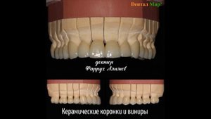 Керамические коронки и виниры при стираемости зубов смешанного типа.