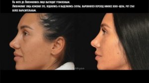 Липофилинг лица, век, губ у Гришкяна Д.Р.