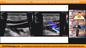 Ликбез: дуплексное сканирование при посттромботическом синдроме