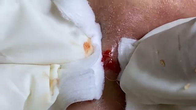 Relaxing Acne Treatment Acnes Treatment  76