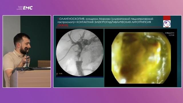12. Роль пероральной транспапиллярной холангиоскопии в диагностике и лечении механической желтухи