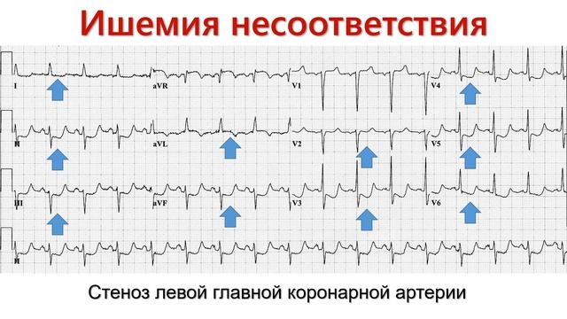 Типы ишемии миокарда