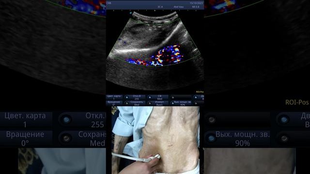 Тромбоз аорты смотреть онлайн