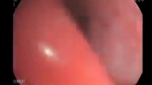 Эндоскопия легких