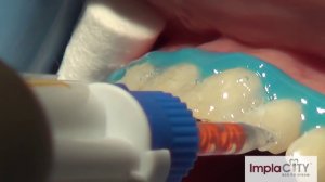 Безболезненное лазерное отбеливание зубов в клинике ImplaCity