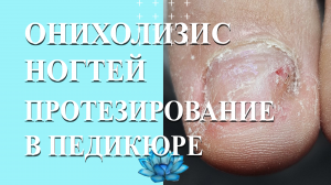Протезирование ногтей и аппаратный педикюр при онихолизисе на ногах.