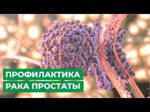 Профилактика рака простаты. Как не допустить рак предстательной железы.
