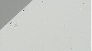 Cперма с очень низкой степенью фертильности под микроскопом